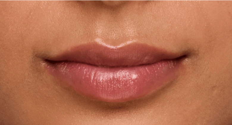 Same JUVÉDERM lip treatment patient after treatment