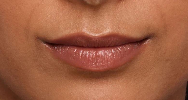 JUVÉDERM lip treatment patient before treatment