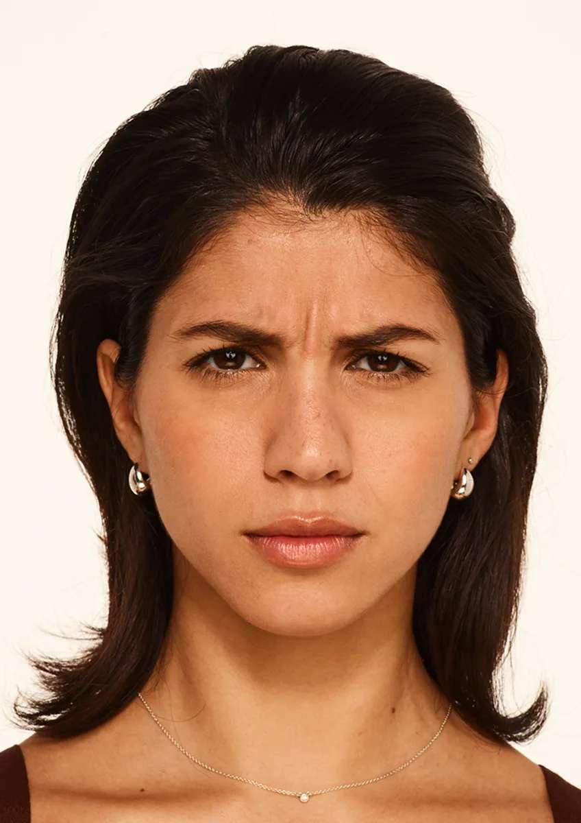 BOTOX Cosmetic patient before treatment at maximum frown